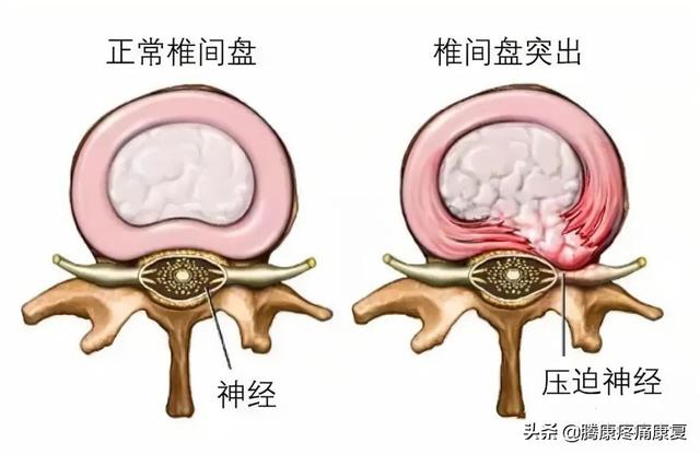 坐骨神经痛的症状和治疗方法（坐骨神经痛的成因和治疗）(7)