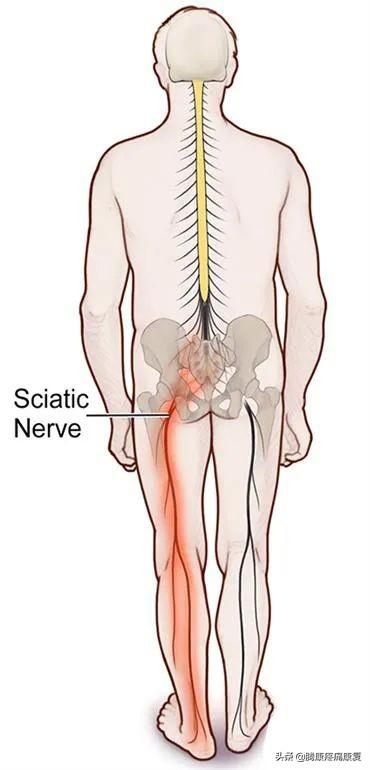 坐骨神经痛的症状和治疗方法（坐骨神经痛的成因和治疗）(2)