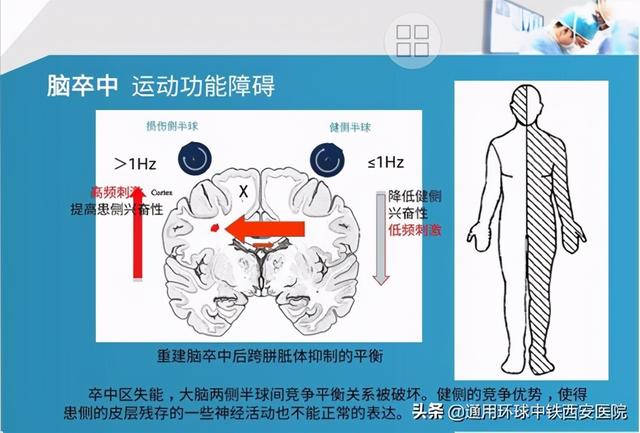 家庭版的经颅磁治疗仪（我院引进新设备）(3)