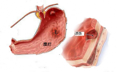 ​糜烂性胃炎吃什么药好得快（一文读懂胃糜烂：胃糜烂能治好吗？吃什么药好？需