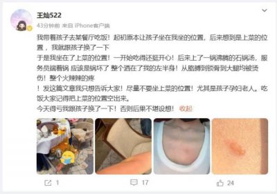 ​杜淳妻子自曝带娃吃饭被烫 皮肤红肿锁骨处起水泡