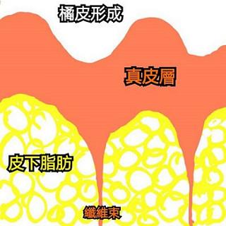 大腿橘皮纹怎么消除 皮肤凹凸不平如何修复